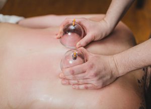 cupping therapy troy michigan